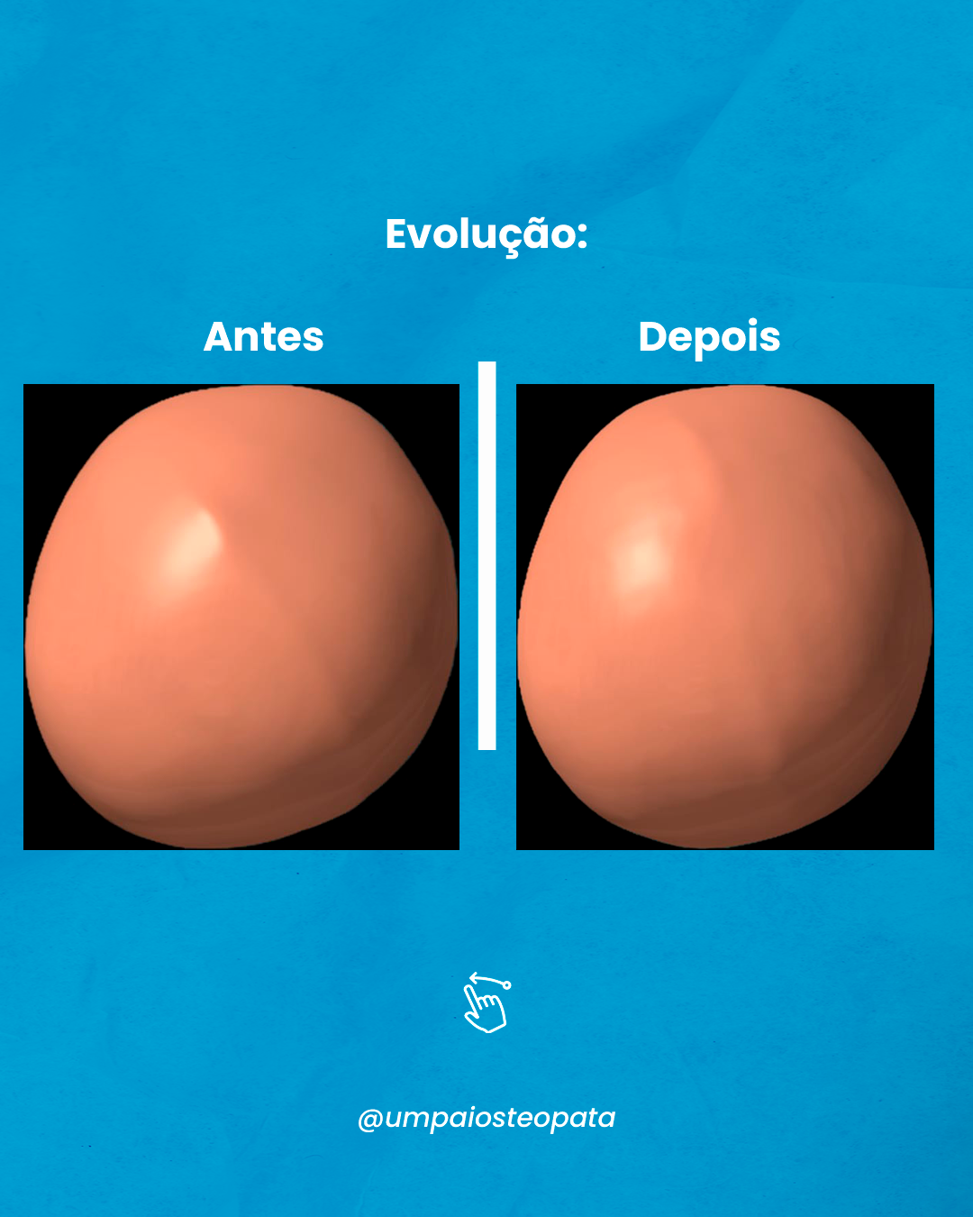 Resultado antes e depois do tratamento de assimetria craniana