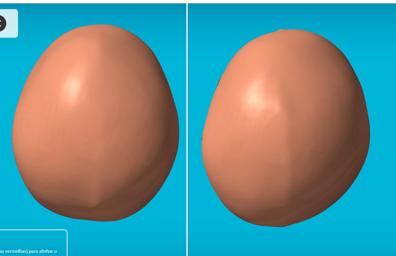 Bebê brincando com órtese craniana